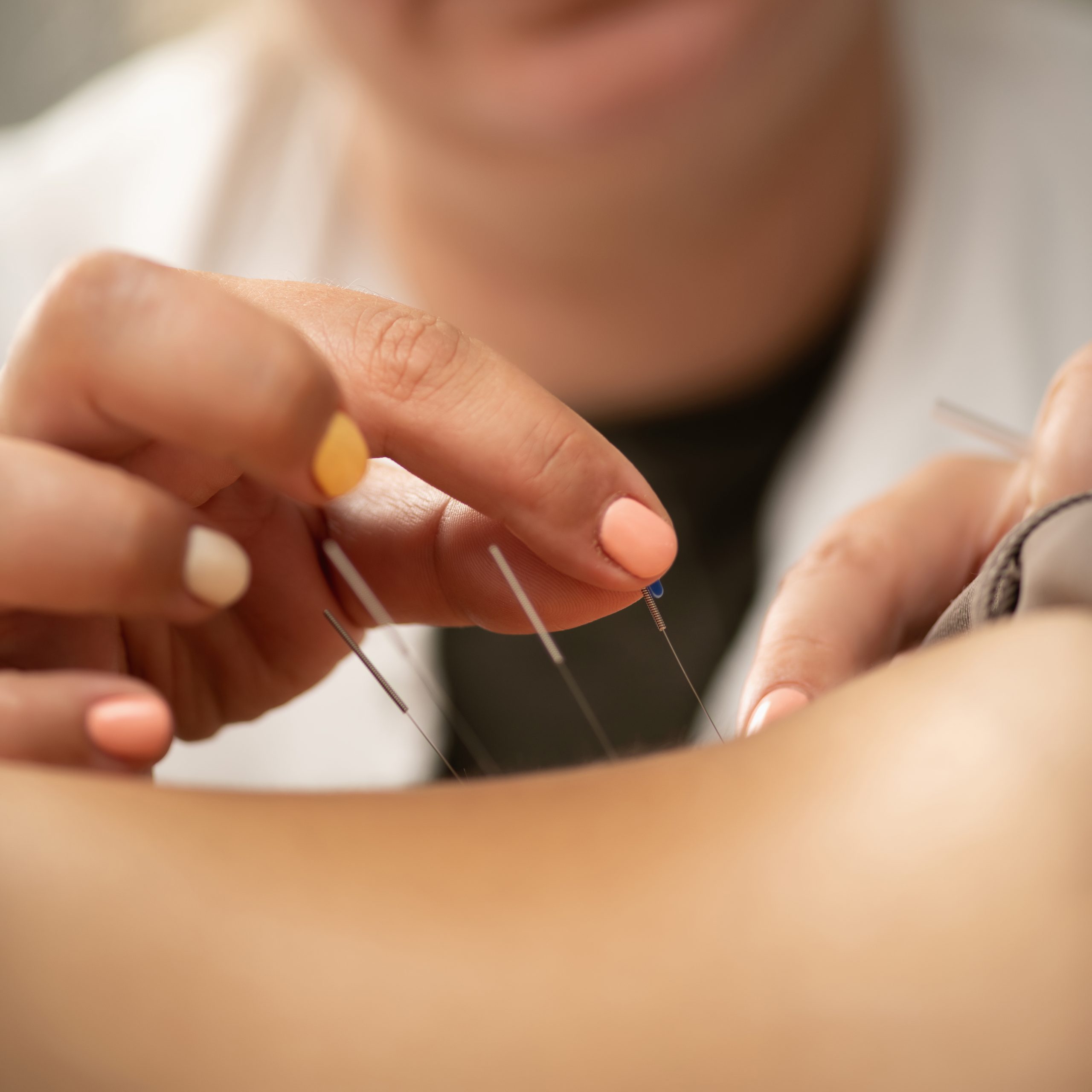 Understanding the Benefits of Acupuncture for Nerve Pain 